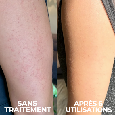 Nuancia — Soin dermocosmétique triple-acide